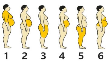 miejsca z nadmierną ilością tkanki tłuszczowej